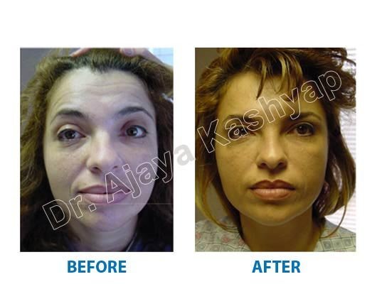 double chin surgery Delhi