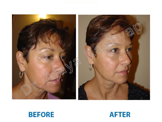 botox treatment for acne scars