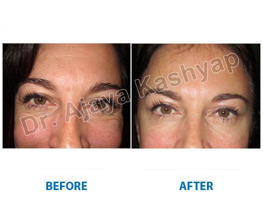 contact for botox treatment
