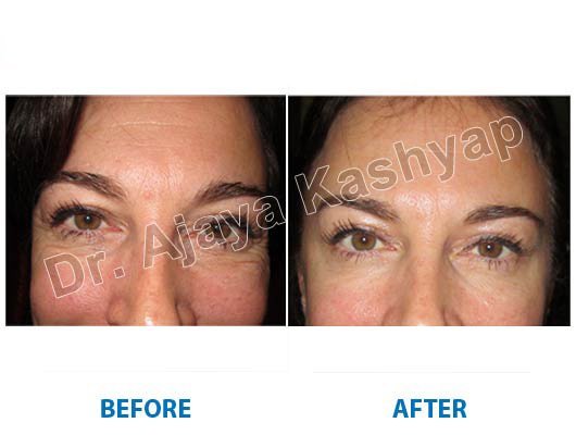 cryo facial clinic in delhi