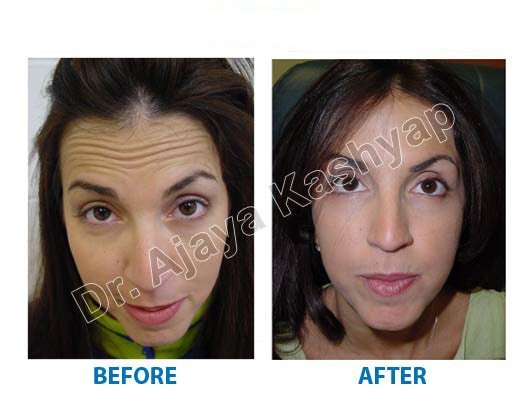 botox treatment in south delhi