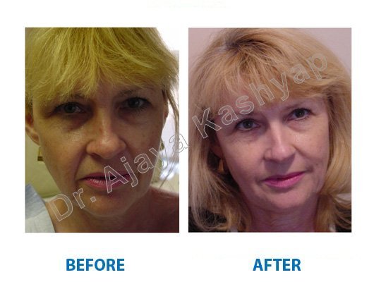 filler skin treatment clinic in Delhi