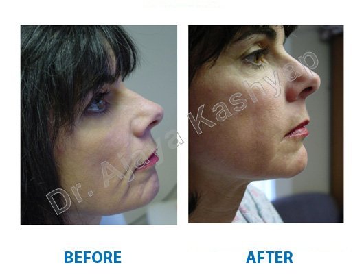 best Medical Facial services in Delhi